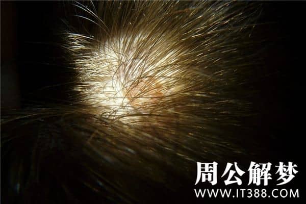 梦见掉头皮屑是什么意思