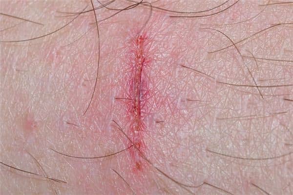 梦见舔伤口是什么意思 梦见舔伤口是什么意思