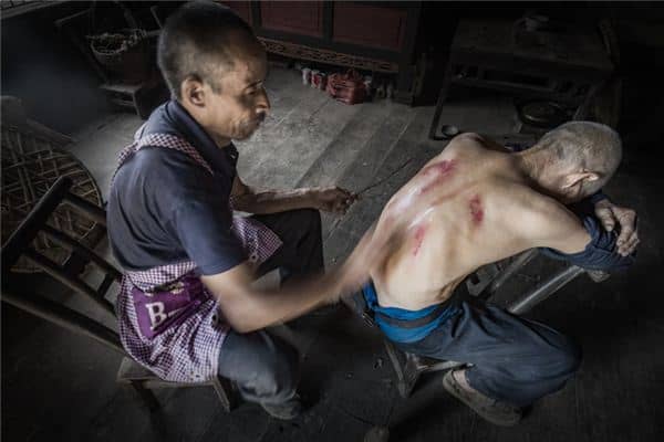 梦见刮痧是什么意思 梦见刮痧是什么意思