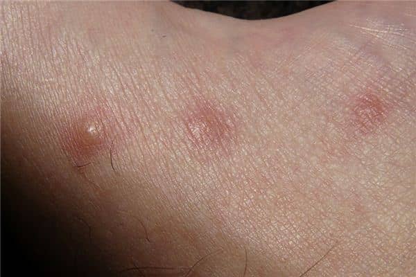 梦见皮肤痒是什么意思 梦见皮肤痒是什么意思