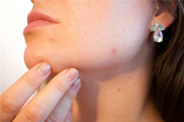 梦见痱子是什么意思 梦见痱子是什么意思