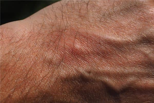 梦见脓疱是什么意思 梦见脓疱是什么意思