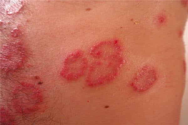 梦见疮痍是什么意思 梦见疮痍是什么意思