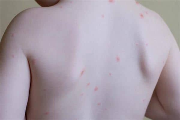 梦见荨麻疹是什么意思 梦见荨麻疹是什么意思