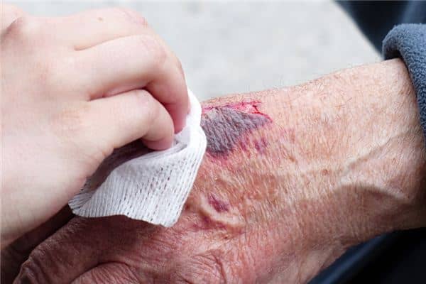 梦见被砸伤是什么意思 梦见被砸伤是什么意思