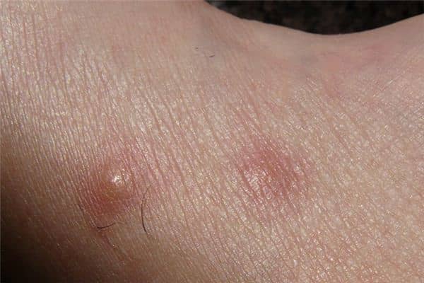 梦见过敏是什么意思 梦见过敏是什么意思