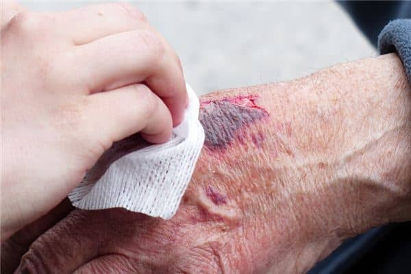 梦见溃疡是什么意思 梦见溃疡是什么意思