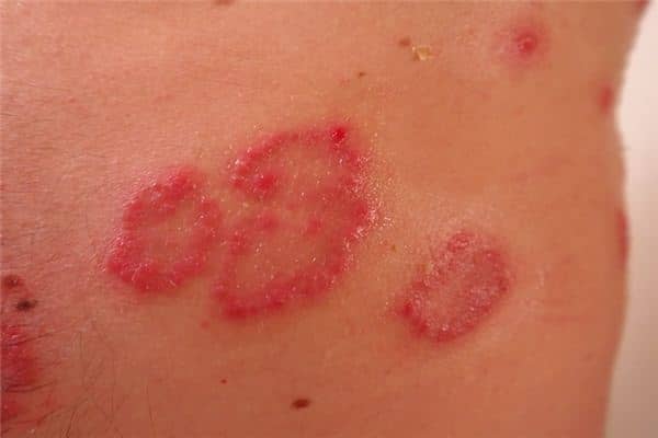 梦见皮疹是什么意思 梦见皮疹是什么意思