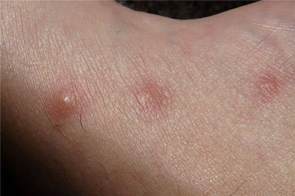 梦见风疹是什么意思 梦见风疹是什么意思