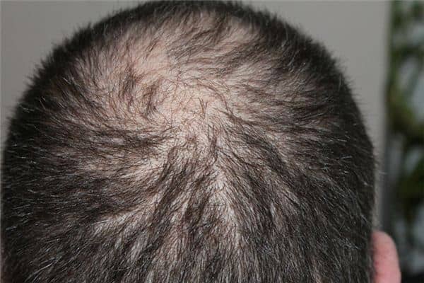梦见头发稀少 梦见头发稀少