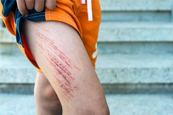 梦见腿流血 梦见腿流血