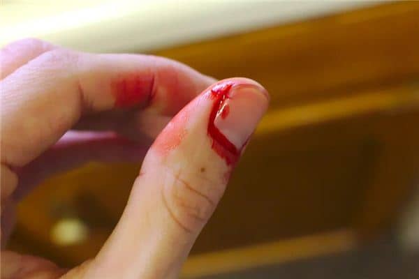 梦见受伤流血 梦见受伤流血