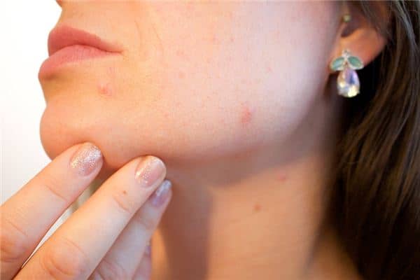 梦见长痘痘是什么意思 梦见长痘痘是什么意思