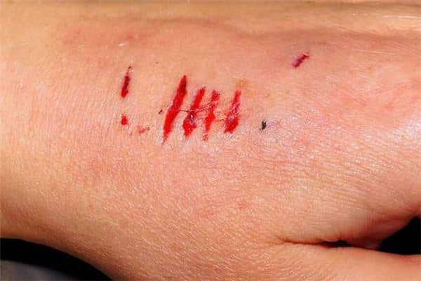 梦见被狗咬伤是什么意思