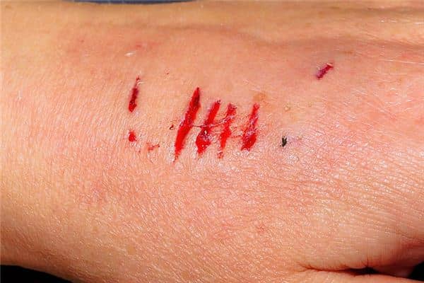 梦见被人咬是什么意思 梦见被人咬是什么意思