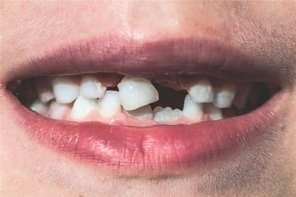 梦见孕妇掉牙是什么意思 梦见孕妇掉牙是什么意思