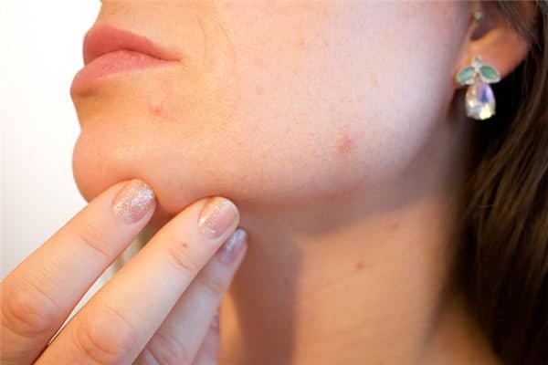 梦见皮肤病是什么意思 梦见皮肤病是什么意思