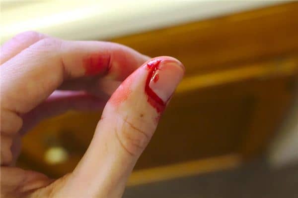 梦见手指破了是什么意思 梦见手指破了是什么意思