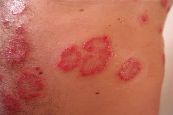 梦见身上长疮是什么意思 梦见身上长疮是什么意思