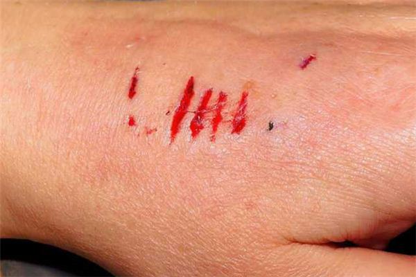 梦见被蛇咬手把蛇打死是什么意思