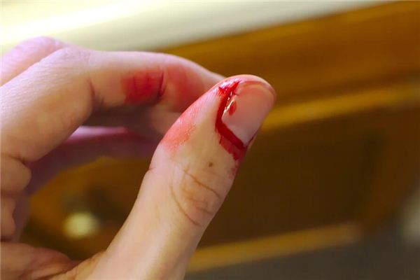 梦见大拇指指甲盖掉了是什么意思