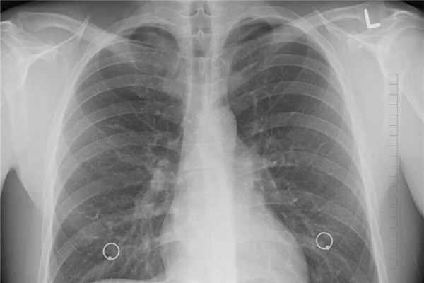 梦到了肋骨断了是什么意思