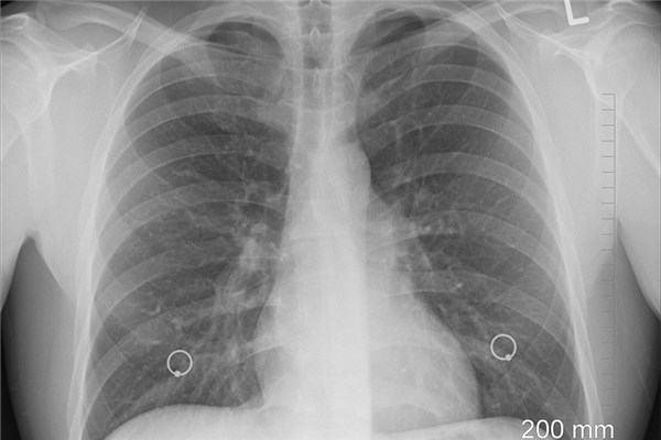 梦见自己得了肺癌是什么意思