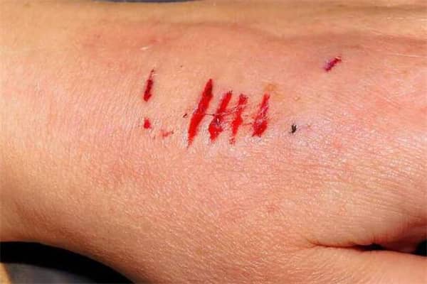 梦到了被狗咬手出血是什么意思